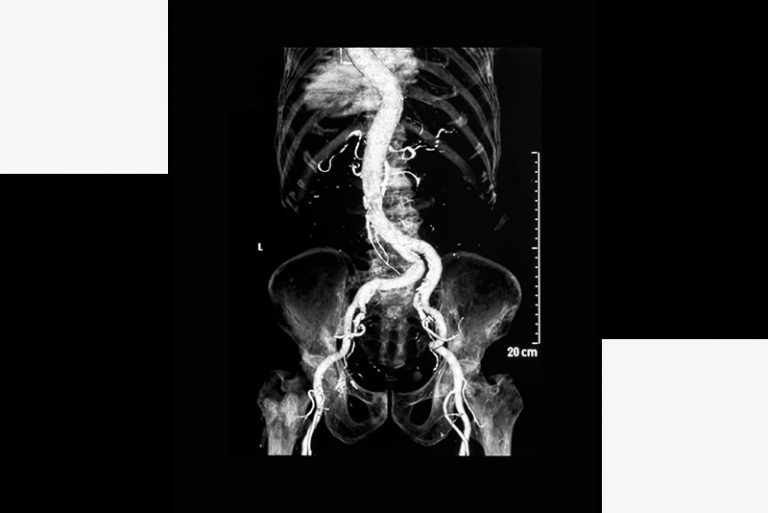 angiography icd 10