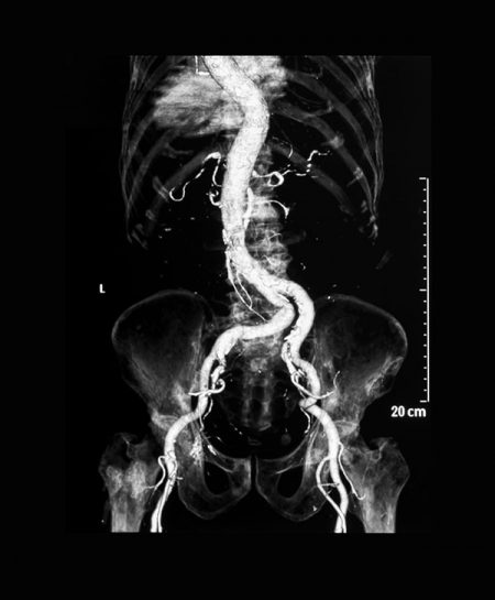 icd 10 angiography