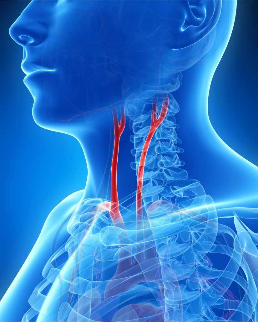 Carotid Endarterectomy Ctvsurgeons