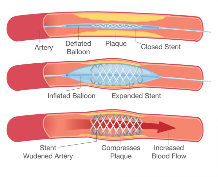 Our Cardiovascular Surgery Services & Procedures | Chicago