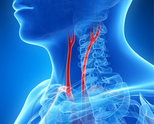 <a id="carotid-endarterectomy">Carotid Endarterectomy</a>