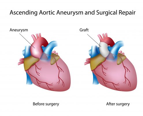 <a id="open-aneurysm-repair">Open Aneurysm Repair</a>