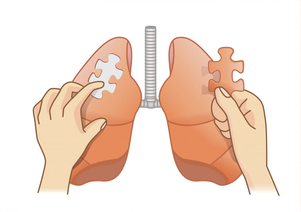 <a id="traditional-open-chest-surgery-thoracotomy">Traditional Open Chest Surgery or Thoracotomy</a>