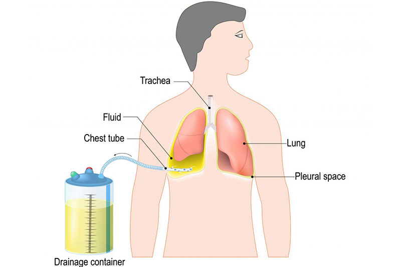 <a id="pleural-chest-tube-placement">Pleural Chest Tube Placement</a>