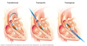 <a id="transcatheter-valve-replacement">Transcatheter Valve Replacement (TAVR)</a>